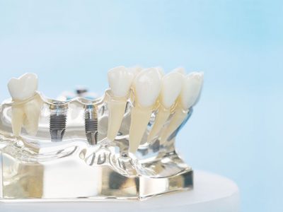 Implantes y enfermedades periimplantarias
