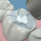 selladores dentales