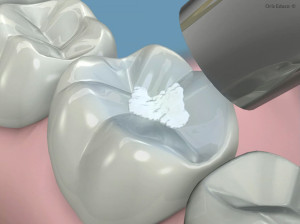 selladores dentales